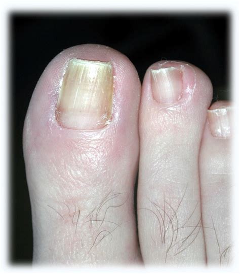 Ingrown Toenail Removal Before And After