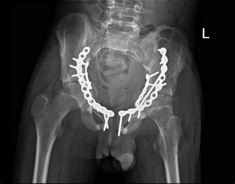 bilateral acetabular fractures induced   epileptic seizure