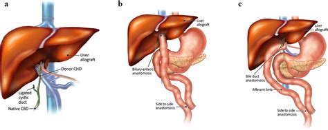 Common biliary anastomoses. a–c Standard end-to-end duct-to-duct (a),... | Download Scientific ...