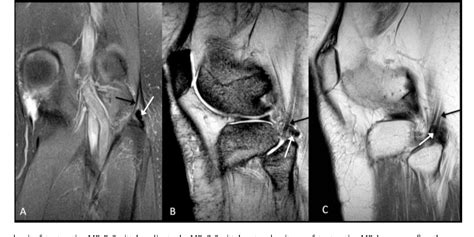 Figure 2 From A Rare Case Of Calcific Tendinitis Of Biceps Femoris