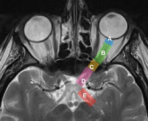 What is optic nerves and why is it so essential to our eyesight?