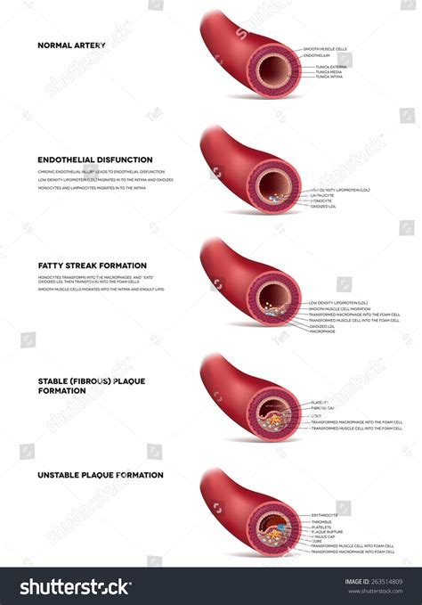 Atherosclerosis Detailed Illustration Progression Till Thrombus Stock