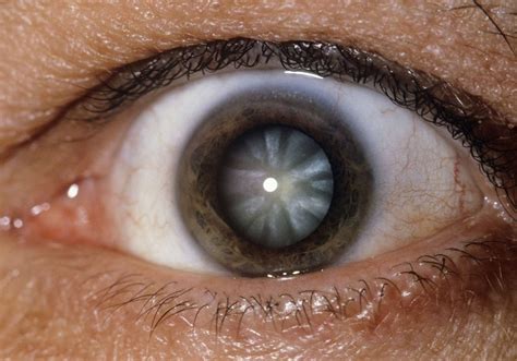 Types Of Cataracts By Location And Origin