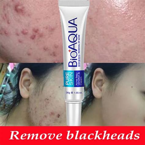 Bioaqua 30g Acne Treatment Blackhead Remova Anti Acne Cream Oil Control