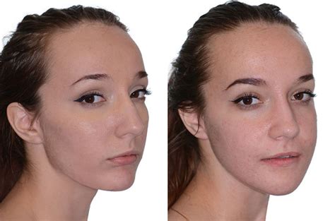 Bite And Chin Asymmetry Correction Corrective Jaw Surgery Dr Antipov