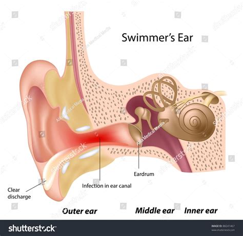 Swimmer'S Ear Stock Photo 88241467 : Shutterstock