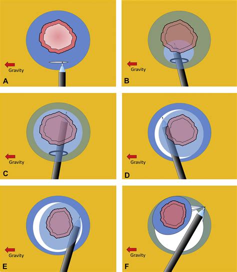 The Pocket Creation Method Facilitates Colonic Endoscopic Submucosal Dissection With Video