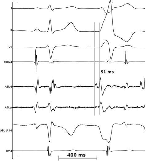 Intracardiac Electrograms Showing The Signals At The Successful Site In