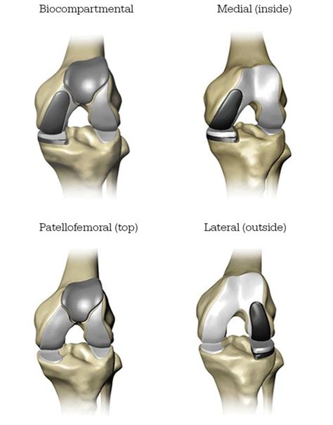 Mako Robotic Partial Knee Replacement Surgery Elkhart Knee Surgeon