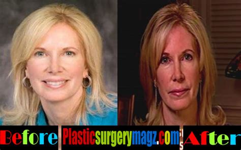 Beth Holloway Plastic Surgery: From Tragedy to Transformation? - Plastic Surgery Magazine