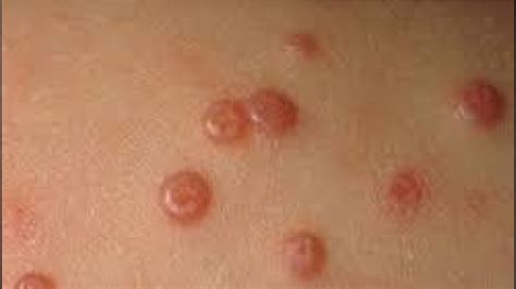 How To Get Rid Of Molluscum Contagiosum At Home Youtube