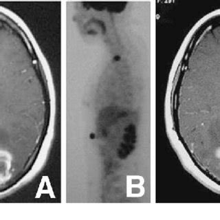 A Preoperative Axial T Weighted Magnetic Resonance Mr Image With