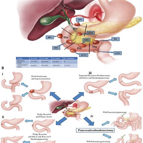 Algorithm For Surgical Management Of Duodenal Gastrointestinal Stromal Download Scientific