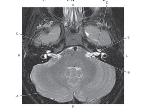 axial T2-weighted MRI of the brain Quiz