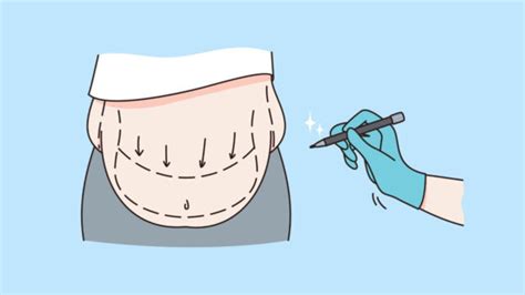 Diferencia Entre Abdominoplastia Y Liposucci N Ejemplos