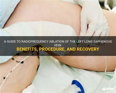 A Guide To Radiofrequency Ablation Of The Left Long Saphenous Vein