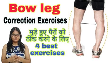 Correct Bow Legs with These Exercises