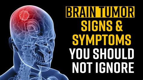 Brain Tumor Day Symptoms Causes And Treatment Watch Video