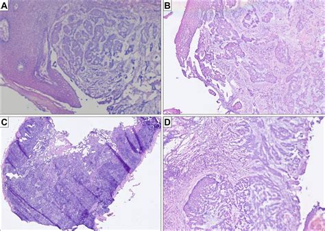 Intraoperative Frozen Section Consultation By Remote Whole Slide