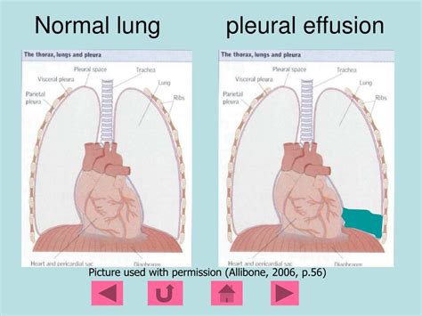 Ppt Pleural Effusions Powerpoint Presentation Free Download Id 224571