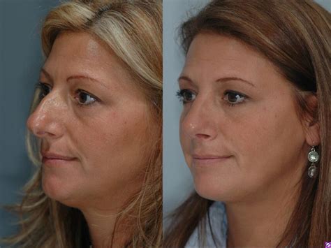 Nose Surgery Before After Long Island Dr Marotta