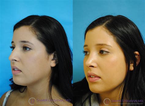 rhinoplasty rhinoplasty nose surgery nose