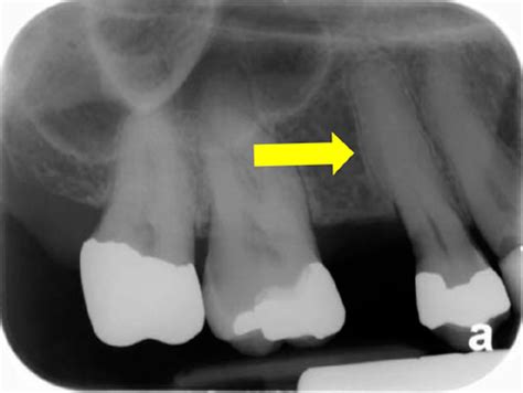 Hypercementosis Dr Gs Toothpix