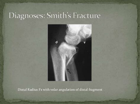 Smith’s fracture