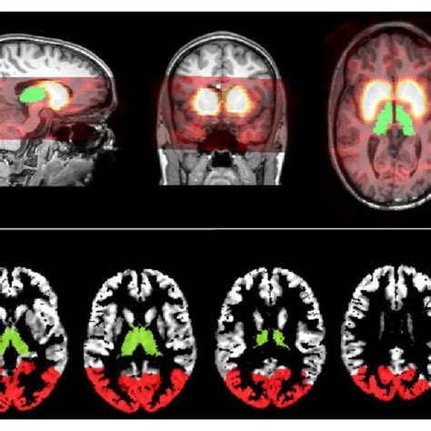 Single Photon Emission Computed Tomography SPECT And Arterial Spin