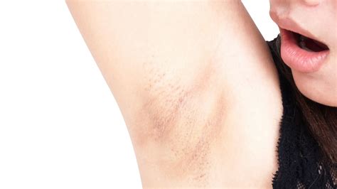 Armpit Rashes: Causes, Symptoms, And How To Treat Them, 58% OFF