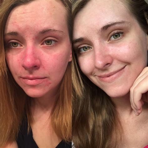 [B&A] What 6 months SCA advice did to my dry, flaky and bright red face : r/SkincareAddiction