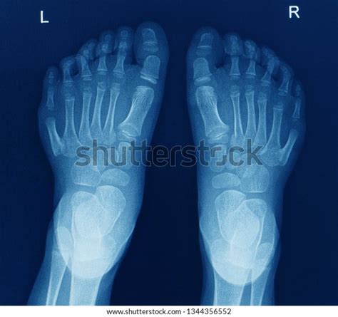 1 232 Imagens De Six Toes Imagens Fotos Stock E Vetores Shutterstock