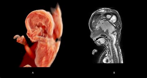 19 Weeks Gestation - 3D Human Development