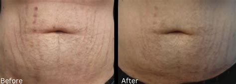 Stretch Marks Dr Chernoff Plastic Surgery