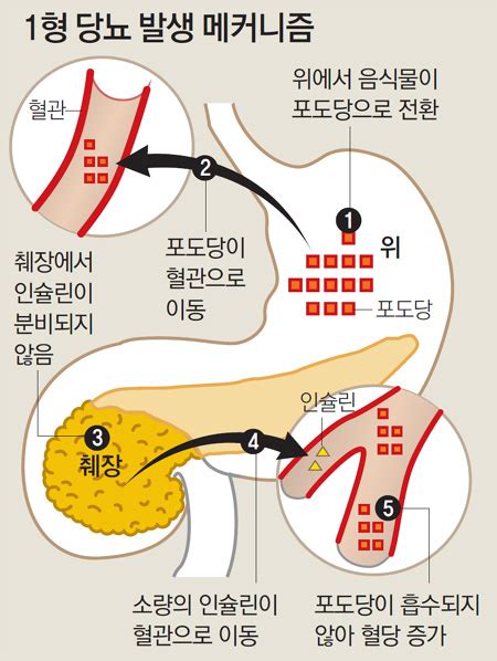 소아 당뇨 성인과 달라 매일 주사 맞아야