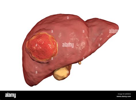 Liver Tumor Stock Photos & Liver Tumor Stock Images - Alamy