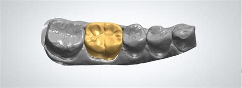 3d Printing And Dental Implants What To Know