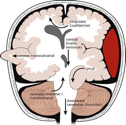 Intracranial Pressure Management | Neupsy Key