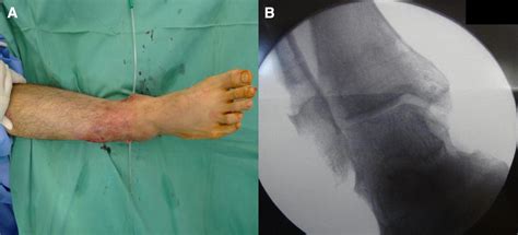 Osteomyelitis After Tightrope® Fixation Of The Ankle Syndesmosis A Case Report And Review Of