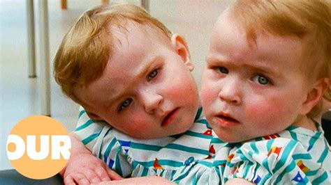 Katie and Eilish: The Unbreakable Bond of Conjoined Twins | Our Life ...