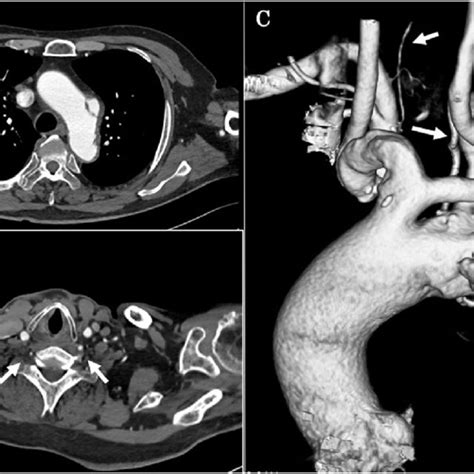 Preoperative computed tomography findings. A The CT revealed a bovine ...