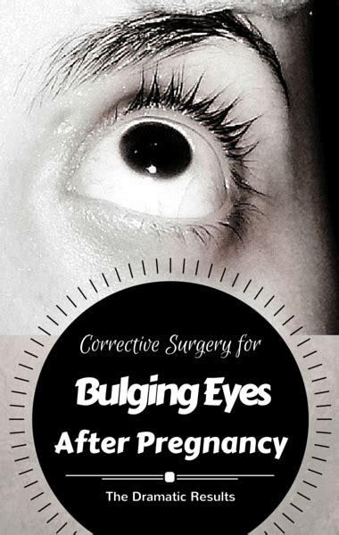 The Drs: Graves' Disease & Bulging Eyes + Corrective Eye Surgery