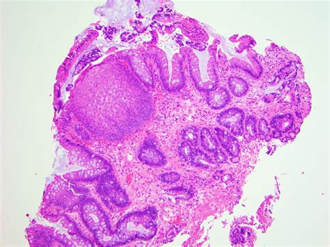 Barretts Esophagus Histology