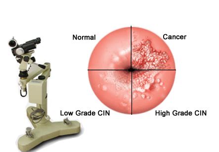 Colposcopy Pictures