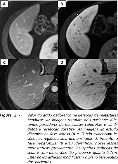 Scielo Brasil Resson Ncia Magn Tica Do F Gado Contraste Hepato