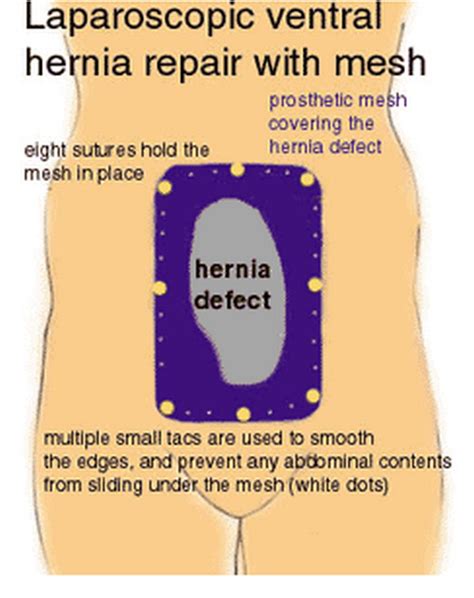 Ventral Hernia - Definition, Symptoms, Causes, Repair, Surgery