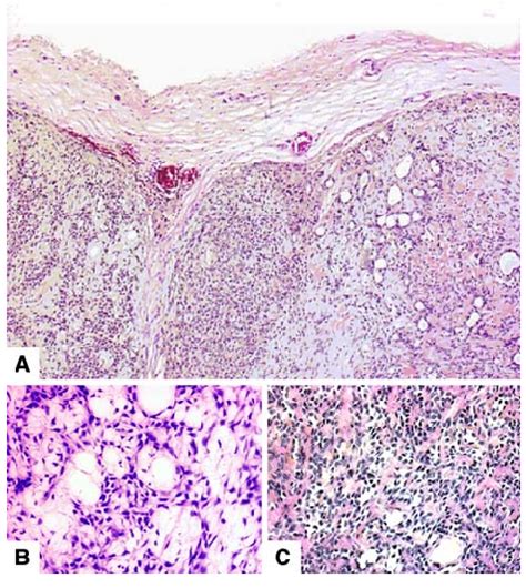 Hematoxylin Eosin Stain Histological Aspect Of The Pleomorphic Adenoma Download Scientific