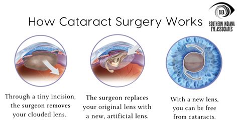 Cataracts — Southern Indiana Eye Associates