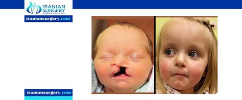 Cleft Palate Surgery