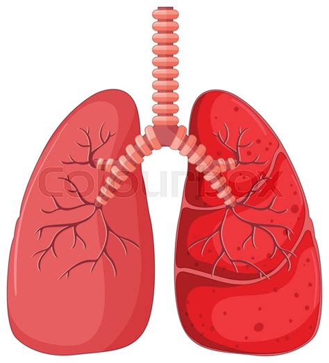 Lung Diagram With Pneumonia Stock Vector Colourbox 3900 Hot Sex Picture